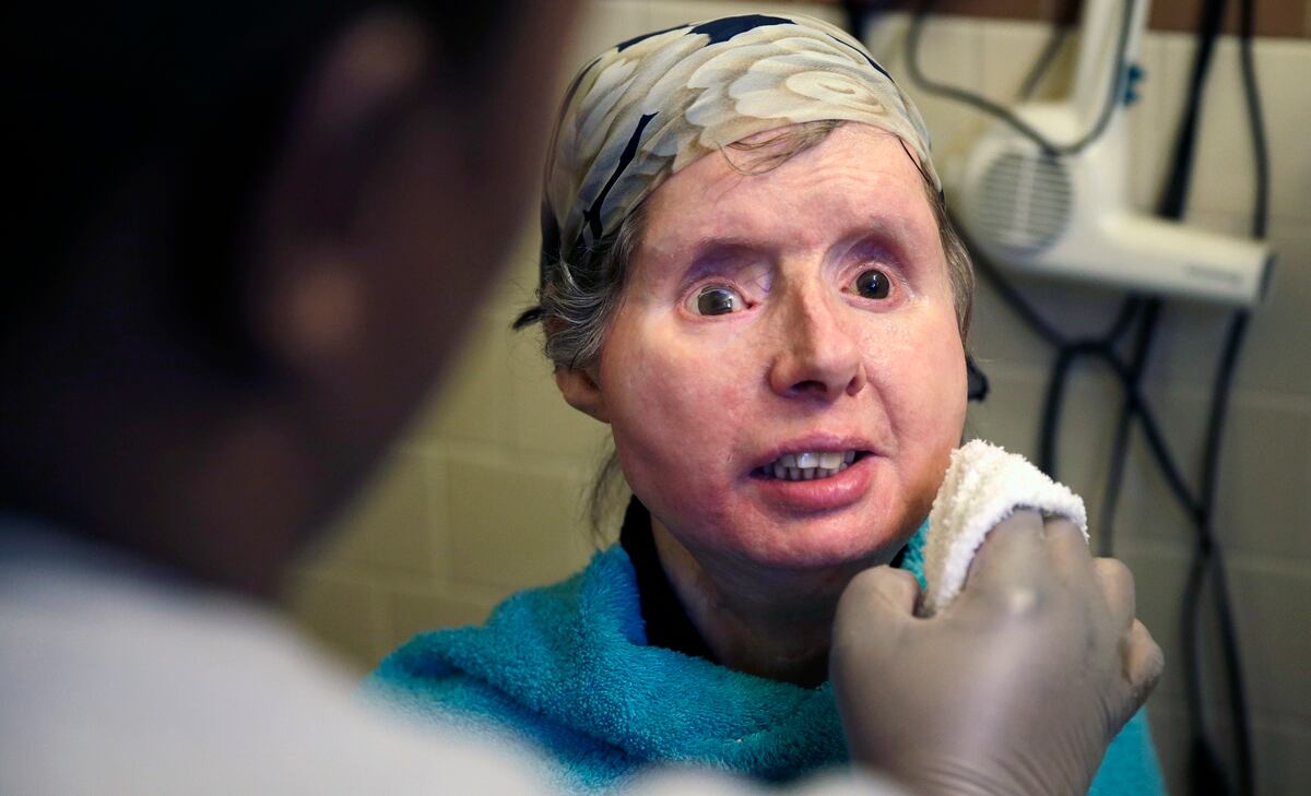 Woman With Dod Funded Face Transplant Suffers Complications A face transplant may be difficult to imagine, but doctors can now transplant part, or all, of a face from a donor. woman with dod funded face transplant