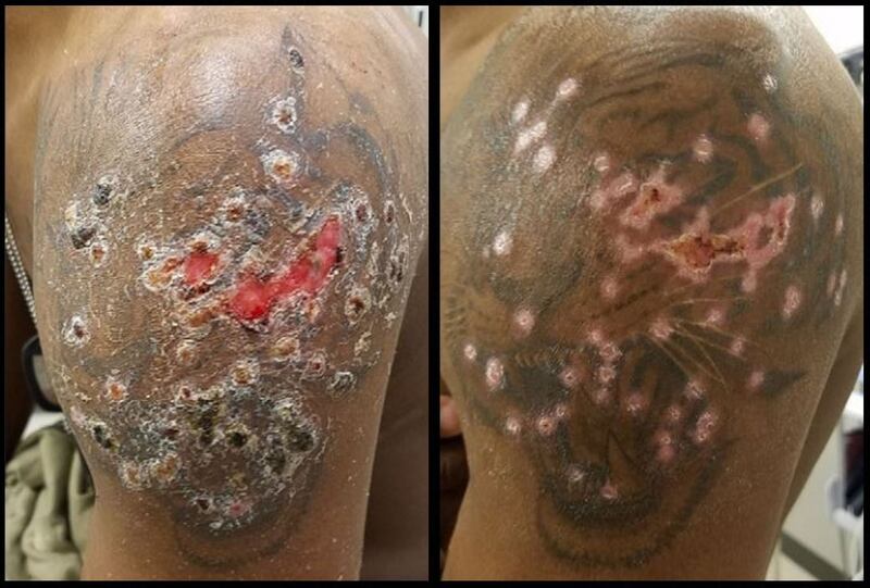 Soldier contracted smallpox sister virus after tattooing ...