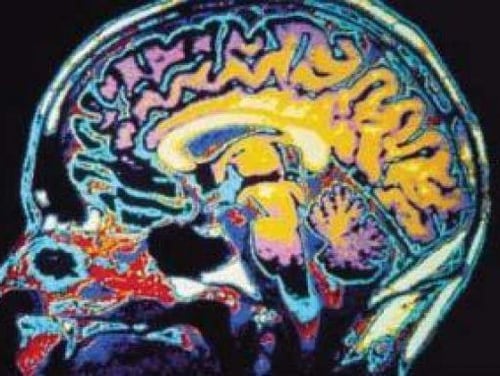 The president is aware of the permanent brain damage that can be caused by TBI, according to the defense secretary. (Army)