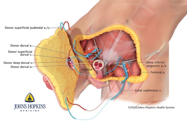 A diagram of the abdominal portion removed from the donor. (Johns Hopkins Medicine)